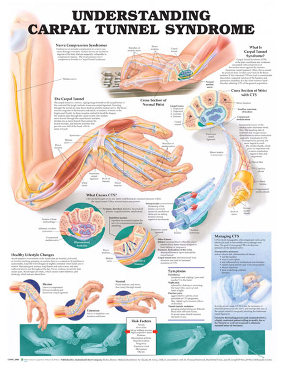 Understanding Carpal Tunnel Syndrome (Laminated) - physio supplies canada