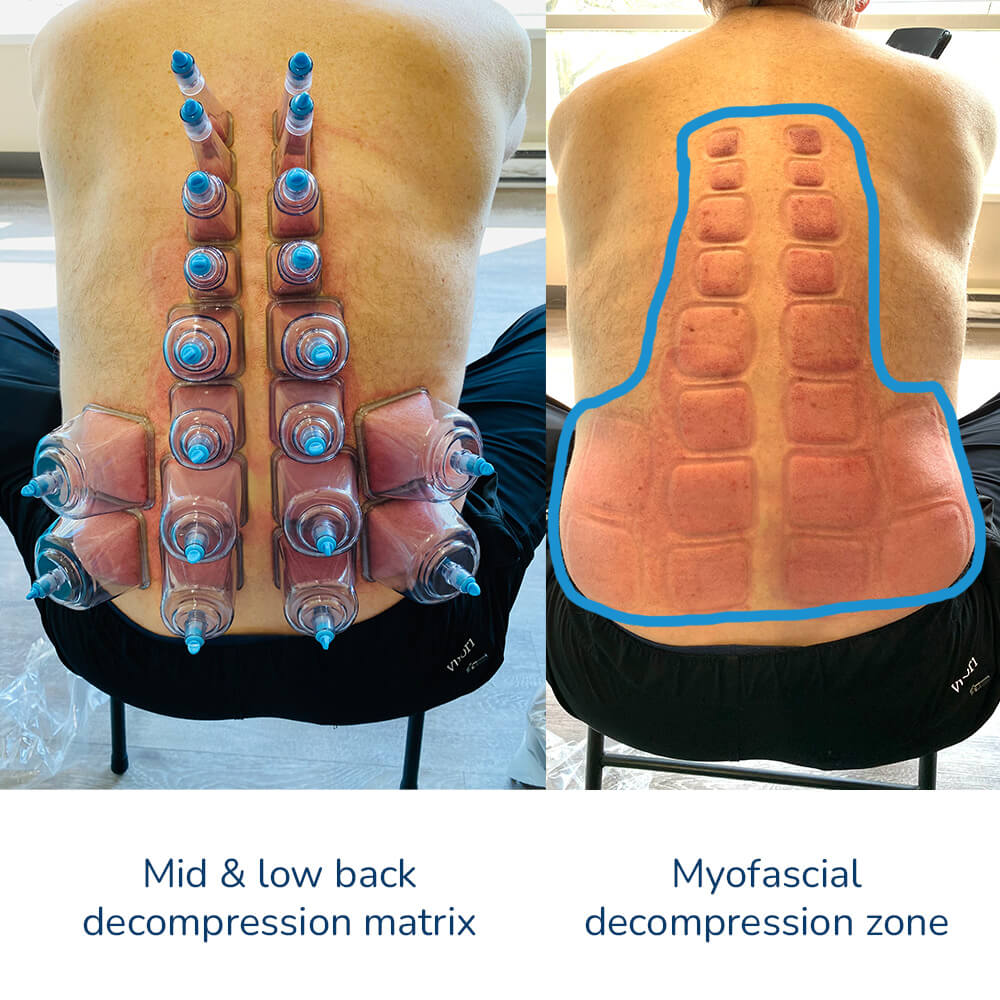 Fascia Buddy Square Cupping Set – 20 pieces