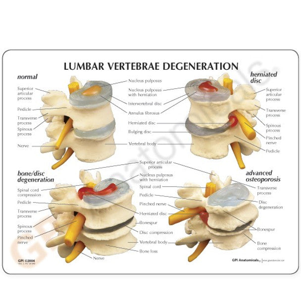 4-stage Vertebrae - physio supplies canada