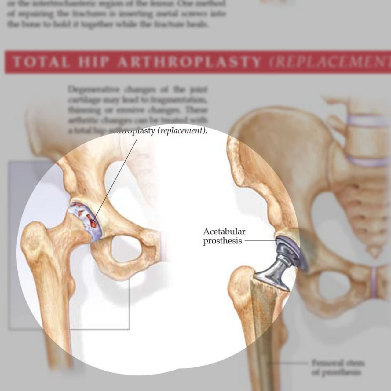 Anatomy and Injuries of the Hip (Laminated) - physio supplies canada