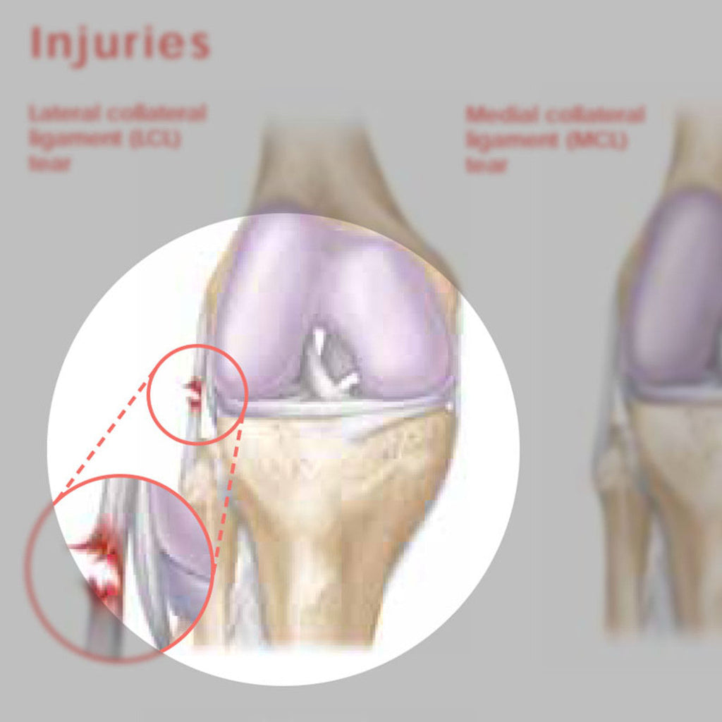 Athletic Injuries of the Knee ( Laminated) - physio supplies canada